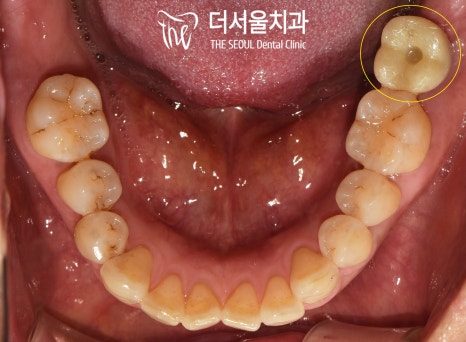 Intraoral photograph of the lower teeth with implant components fitted at the back