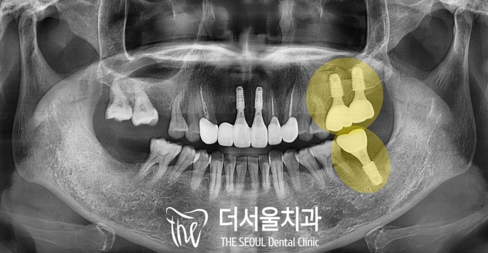 Sinus Lift and Bone Graft for Molar Implants: A Staged Case