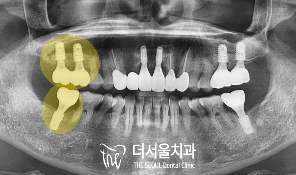 Panoramic dental X-ray with the damaged back teeth highlighted in yellow on one side