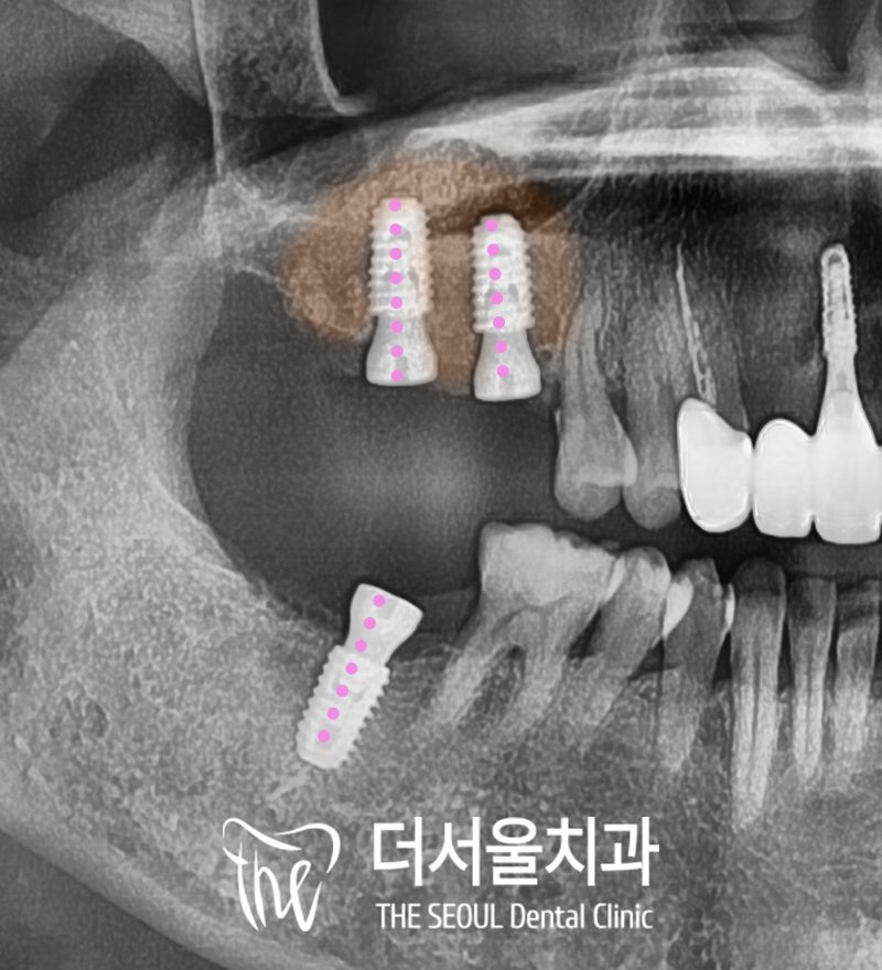 Cropped panoramic X-ray of the upper back teeth with two implant fixtures in place and the bone above them highlighted