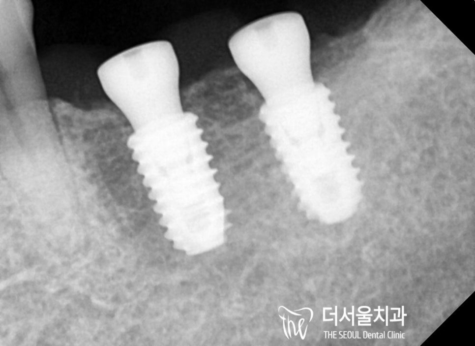 Close-up dental X-ray of two implant fixtures seated in the jaw