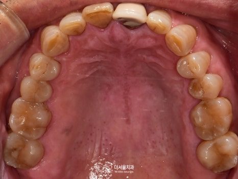 Intraoral photograph of the upper teeth from below with the restorations finished
