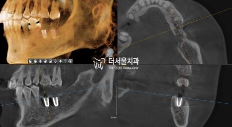 Three-dimensional CT reconstruction of the jaw shown beside cross-sectional slices of the implant sites