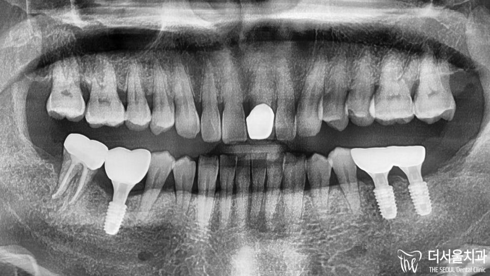 Implants and Cavities Together: Which Comes First?