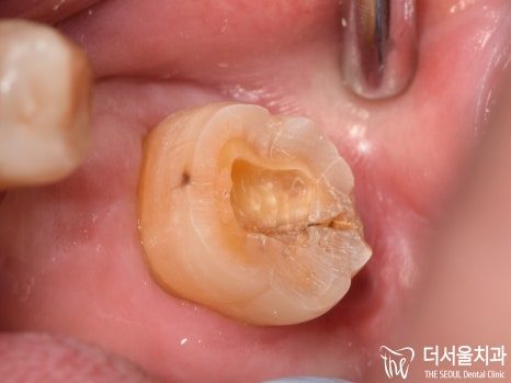 Close-up photograph of a molar broken down by decay, seen in the mouth