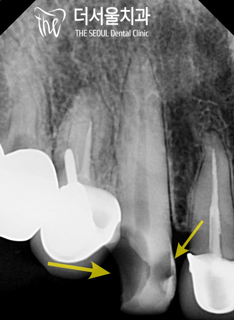 A Broken Canine From Untreated Decay: Root Canal or Implant?