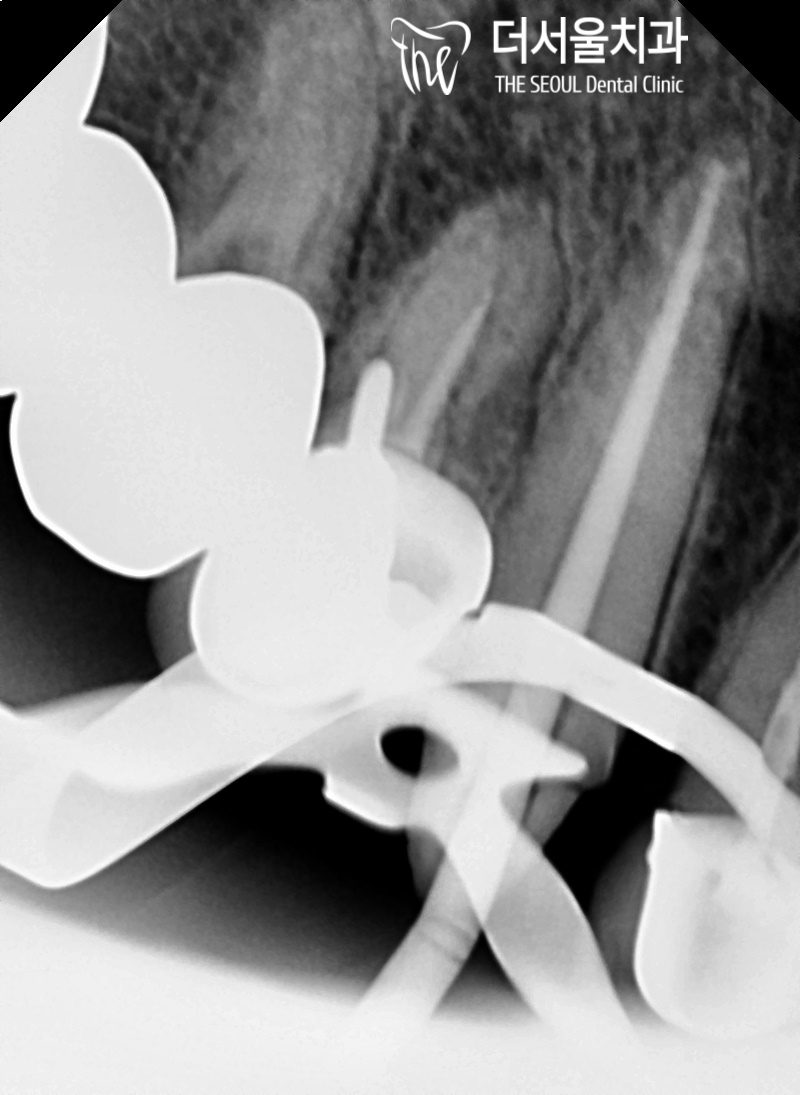 Close-up dental X-ray of the upper front teeth showing the crowned tooth and the root beneath it