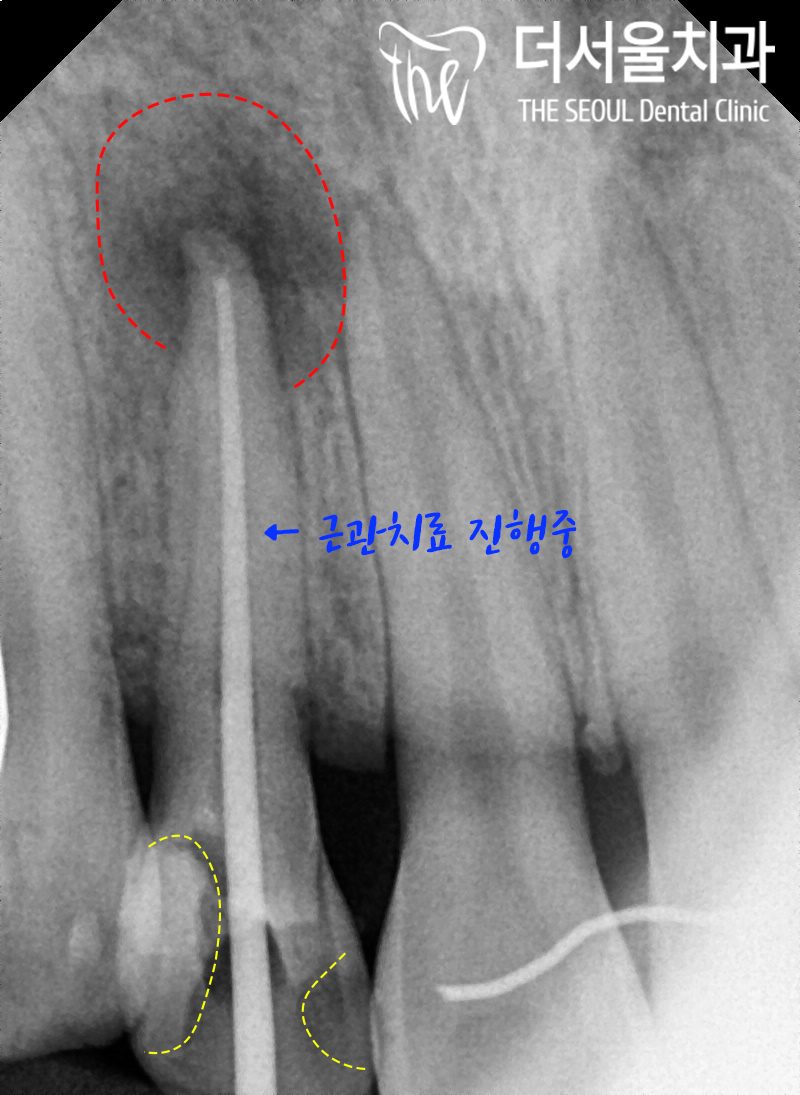 Close-up dental X-ray of an upper front tooth outlined in red where root canal treatment was needed