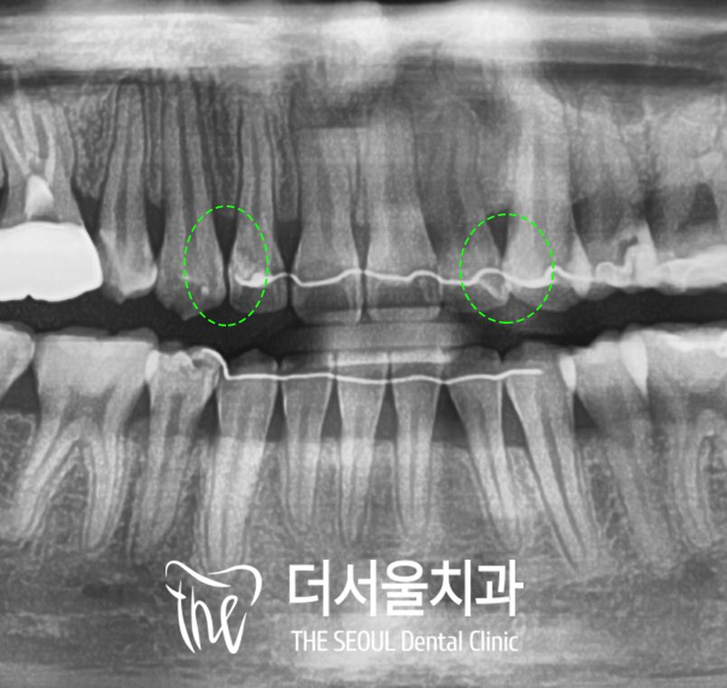 A set of small dental X-rays of the front and side teeth with green marks on the areas of concern