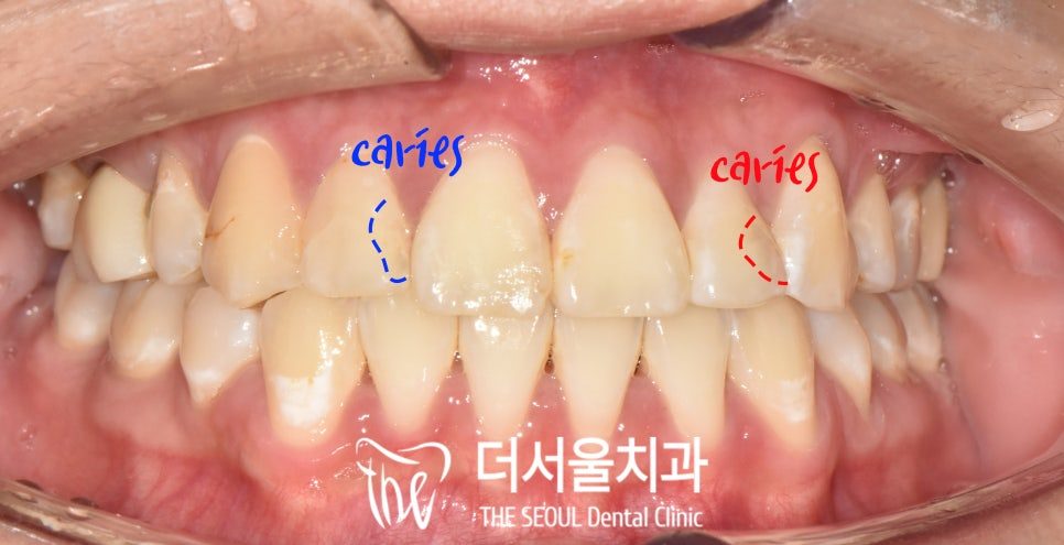 Front Tooth Decay After Braces, With a Fixed Retainer in Place