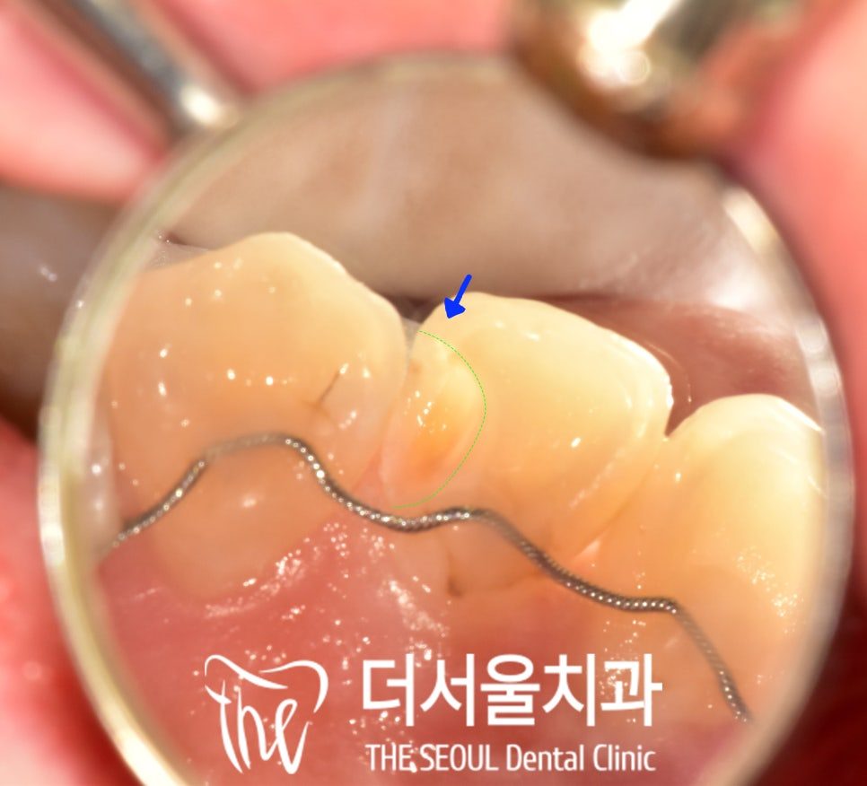 Close-up mirror view of a front tooth with an arrow marking the filled area