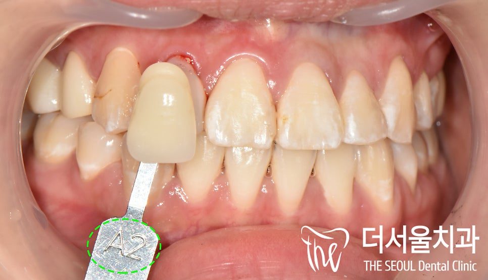 Intraoral photograph of the upper front teeth with a shade guide held alongside them to match the colour