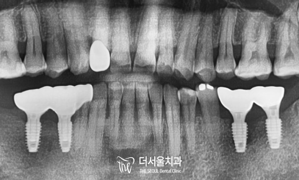 Implant Treatment Under Sedation When You Are Afraid of the Dentist