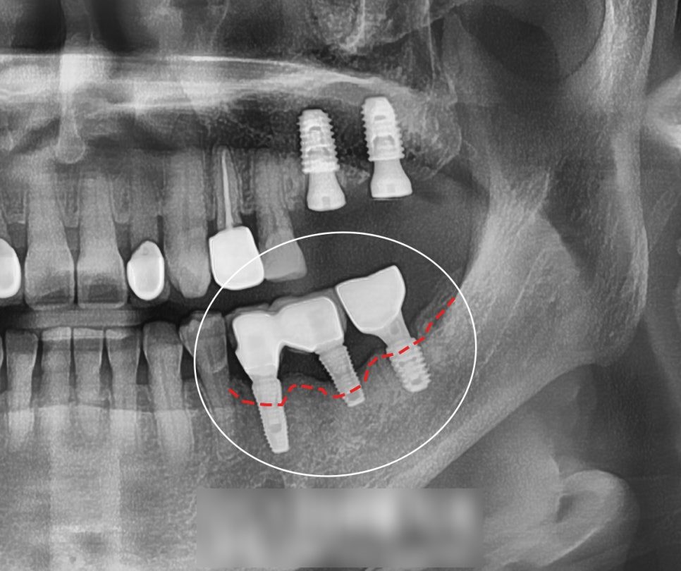 A Loose, Painful Implant: Removal, Bone Graft and Re-Placement
