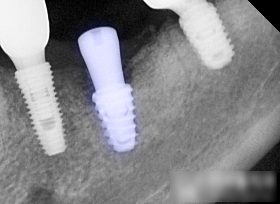 Close-up dental X-ray of an implant fixture with its healing cap fitted