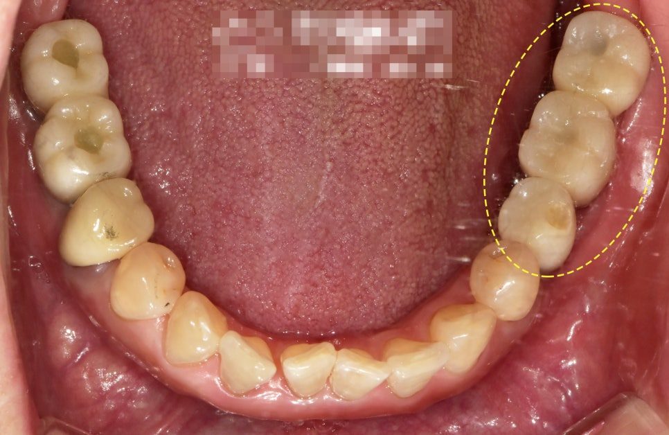 Intraoral photograph of the lower teeth with the affected back area circled