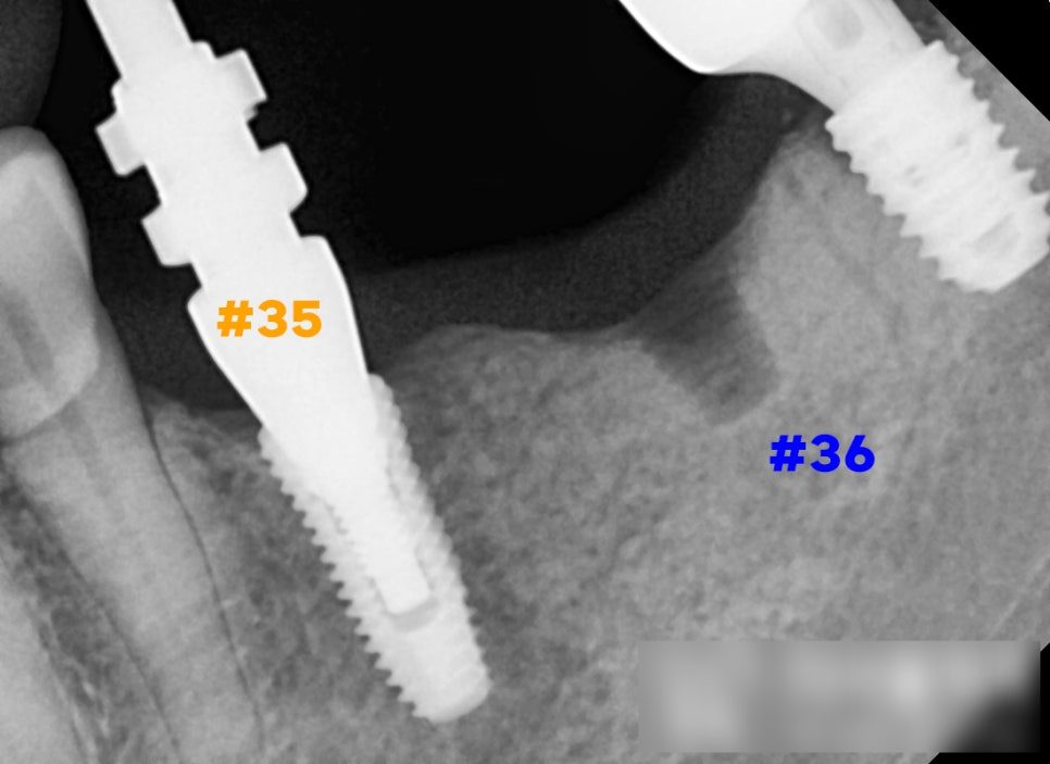 Close-up dental X-ray labelled in English showing the replaced implant beside the neighbouring molar site