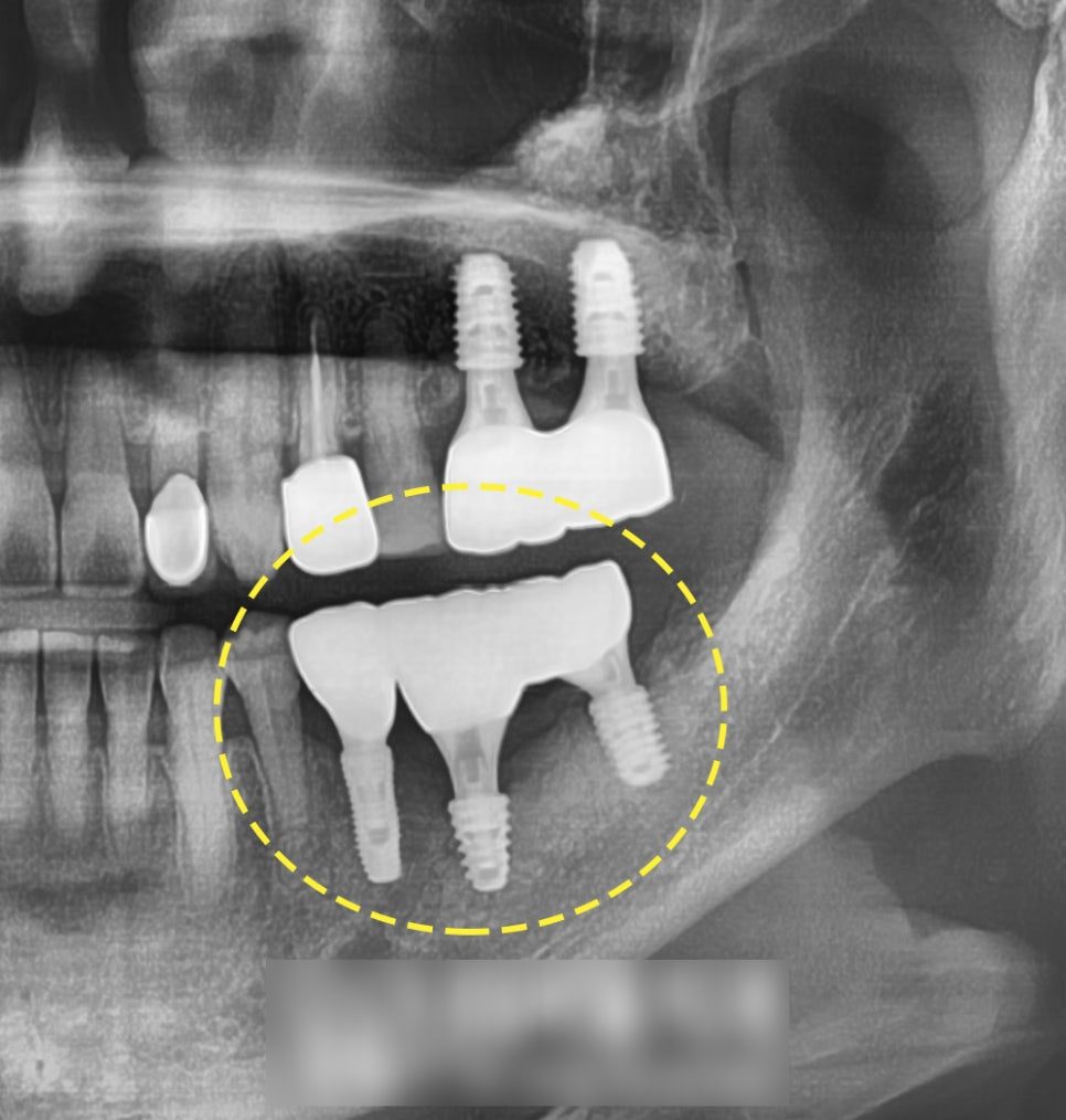 Cropped panoramic dental X-ray with two joined implant crowns circled