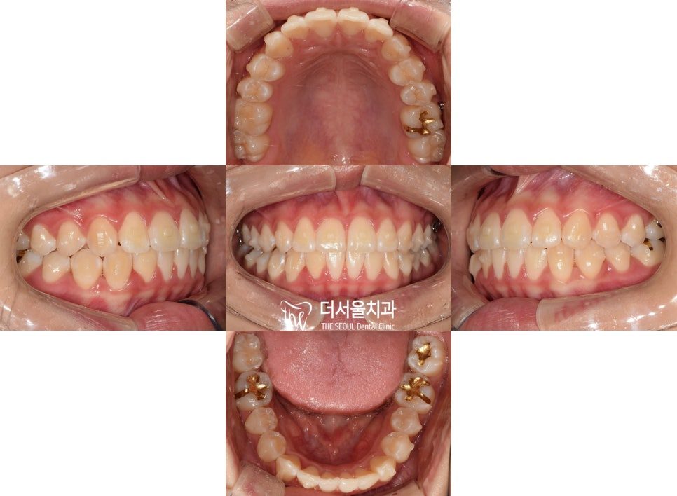 A set of five intraoral photographs showing the teeth from the front, both sides, above and below at the start of treatment