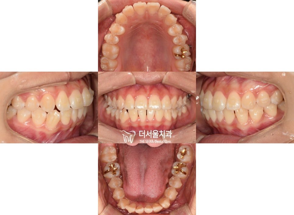 A set of five intraoral photographs showing the teeth partway through aligner treatment