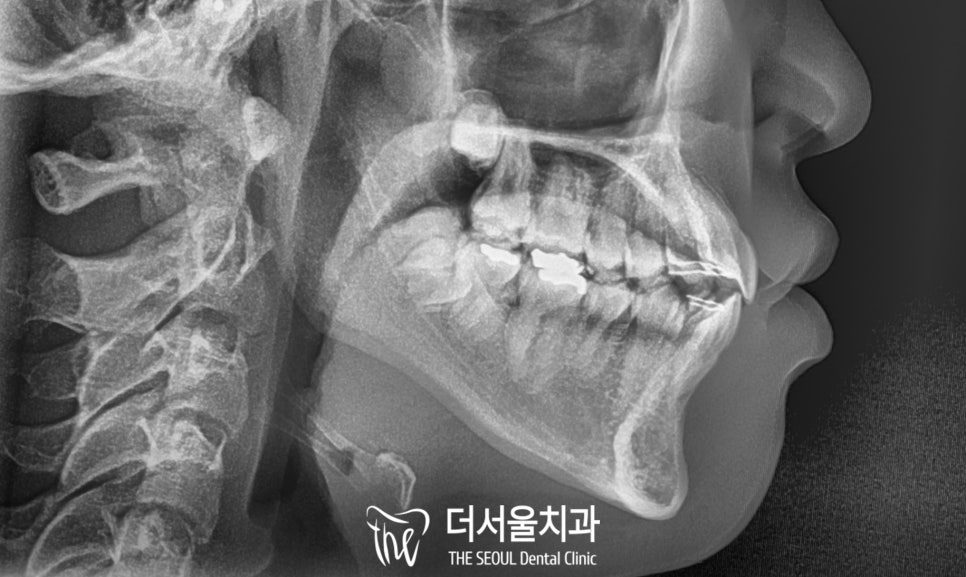 Lateral cephalometric X-ray of the skull in profile, used for orthodontic planning