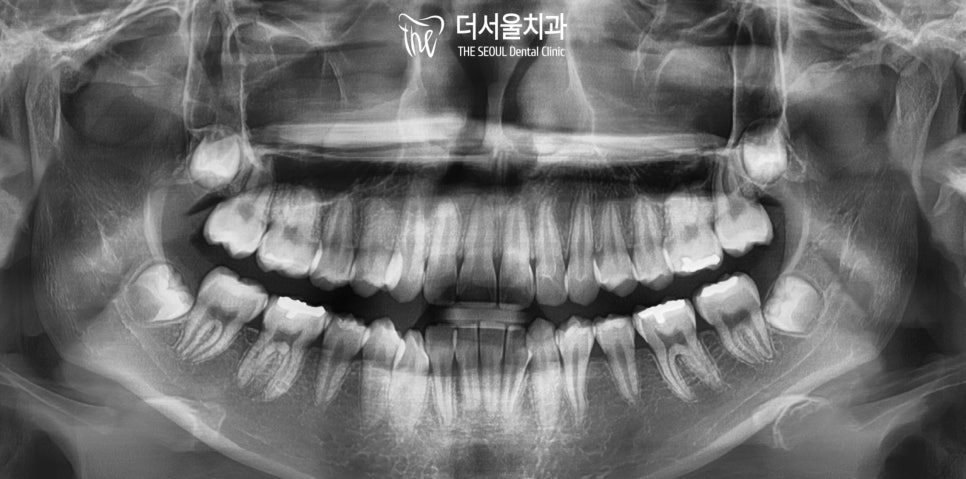 Invisalign in Korea: Treatment Time, Discomfort and What It Costs