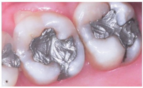 Severe Pain Under an Old Amalgam Filling: Secondary Decay