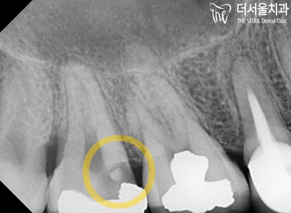 Close-up dental X-ray with the area beneath the filling circled