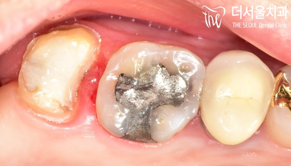 Close-up photograph of a back tooth with an old amalgam filling and decay spreading around its edges
