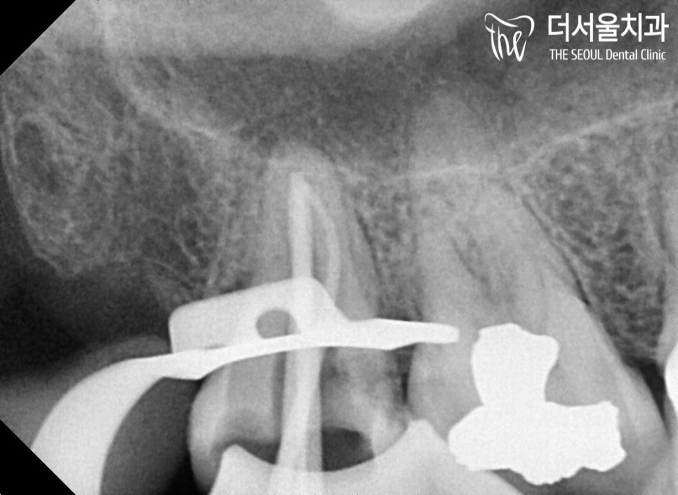 Close-up dental X-ray taken during root canal treatment with the rubber dam clamp visible