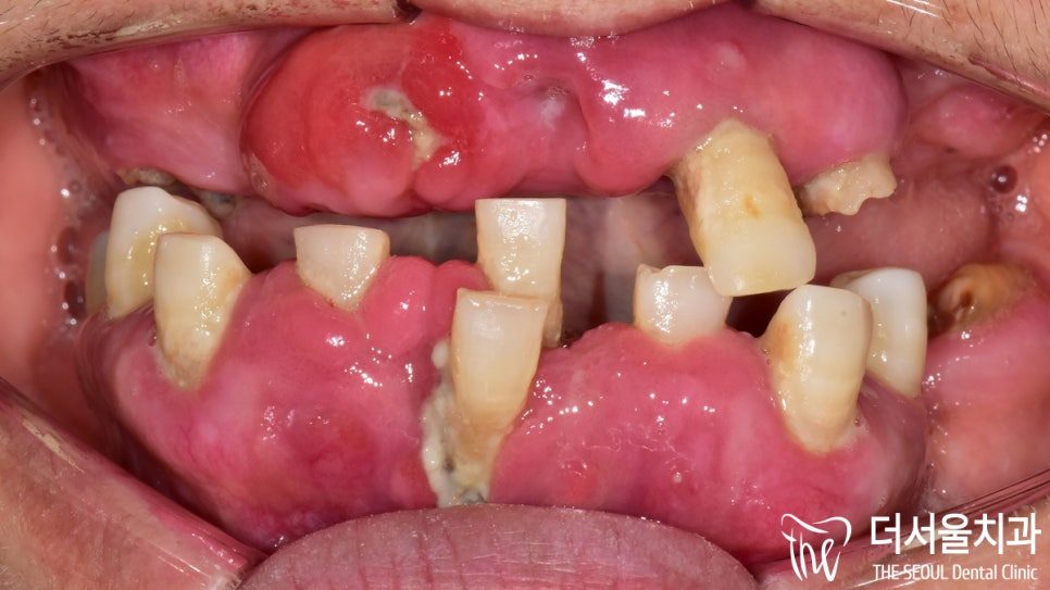 Intraoral photograph showing teeth badly damaged by advanced gum disease, with receded and inflamed gums