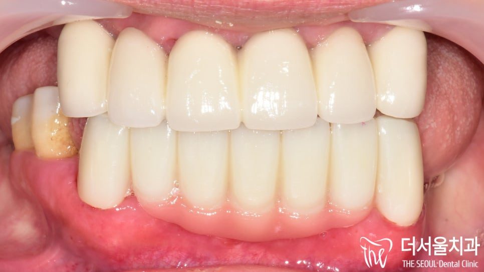 Implants With Advanced Gum Disease: Treating the Gums First
