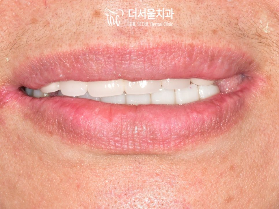 Close-up photograph of the mouth at lip level with the finished teeth visible
