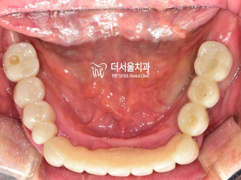 Intraoral photograph of the lower teeth with the finished restorations