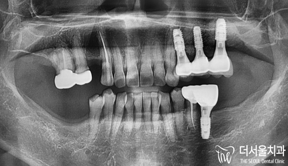 Years After Losing a Molar: Sinus Lift, Bone Graft and Implants