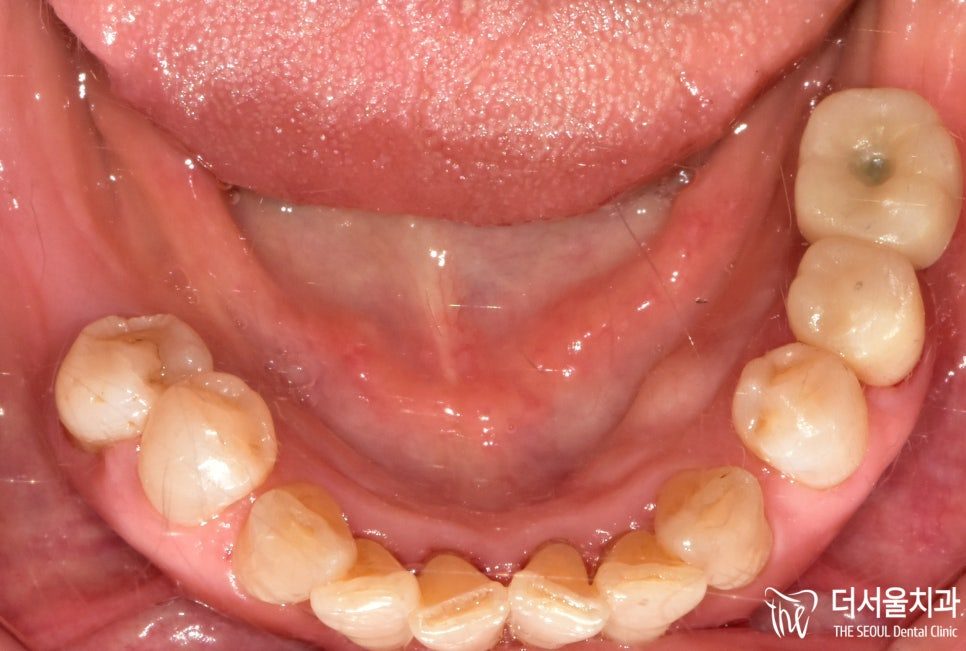 Intraoral photograph of the lower teeth with the finished restorations at the back