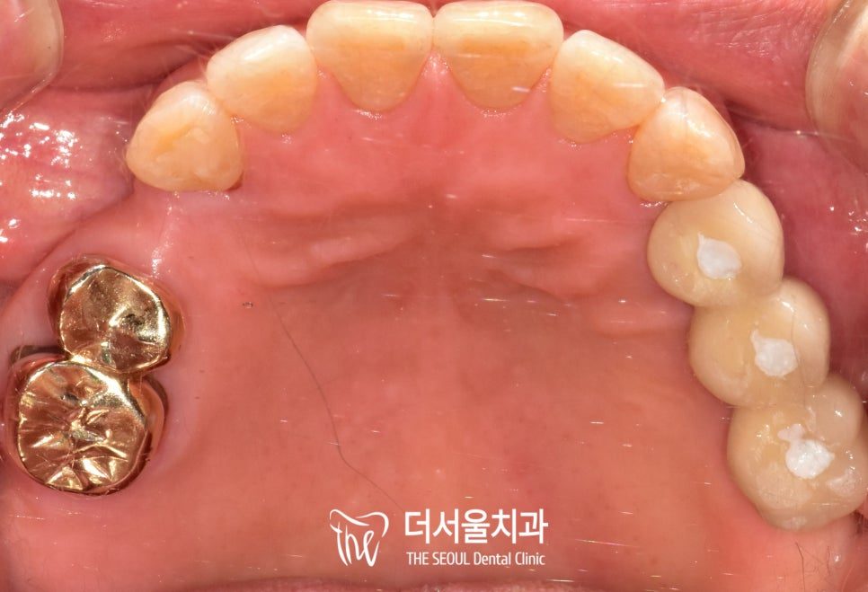 Intraoral photograph of the upper teeth from below, with gold crowns and a gap at the back
