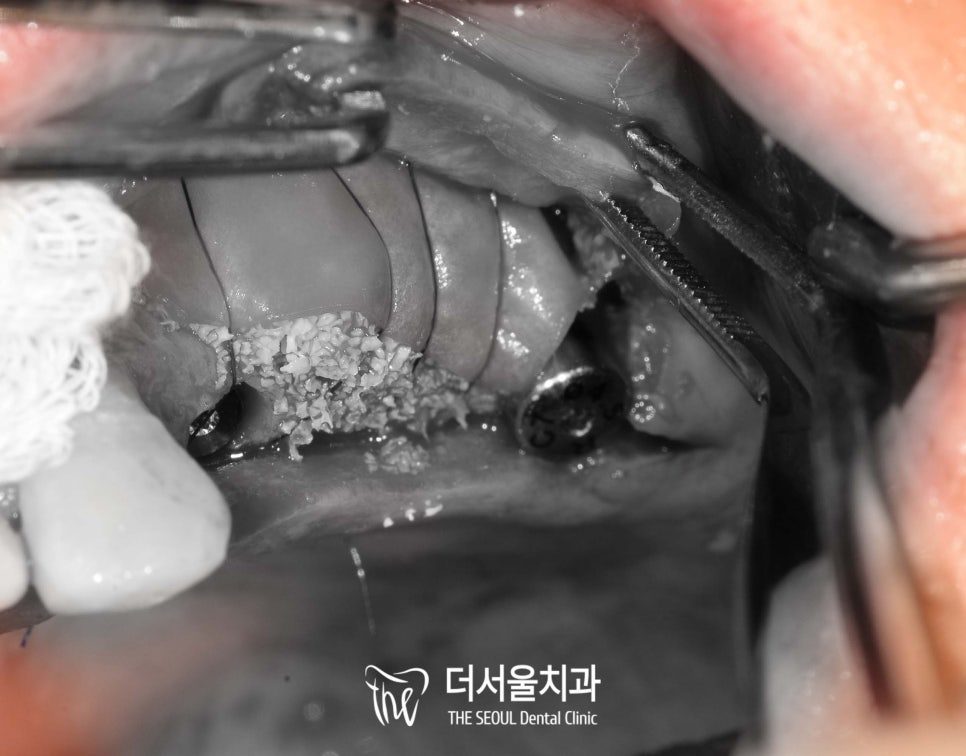 Close-up surgical photograph of the upper jaw with the bone graft placed at the implant site