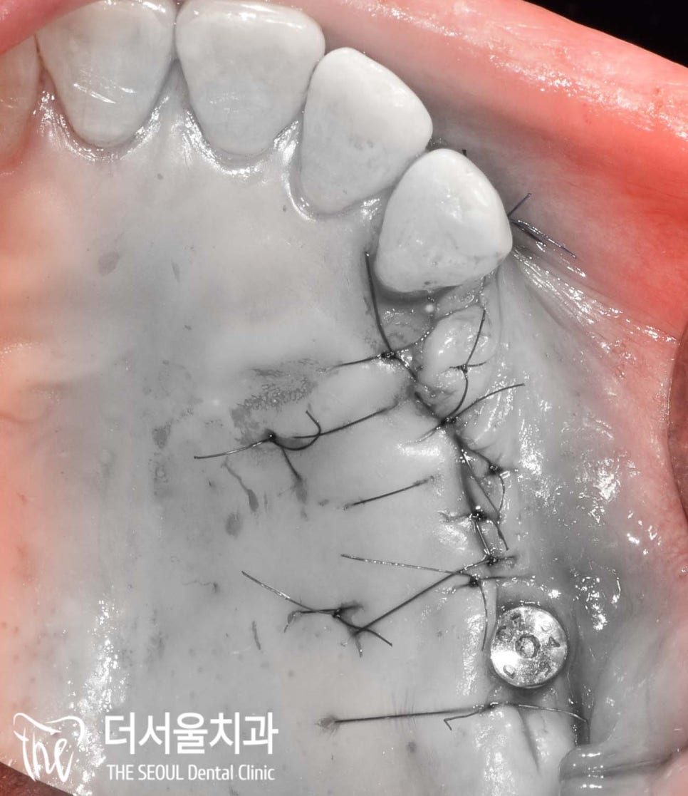 Close-up surgical photograph of the site closed with sutures
