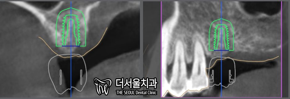 CT cross-sections of the upper jaw with the planned implant drawn into the bone in green