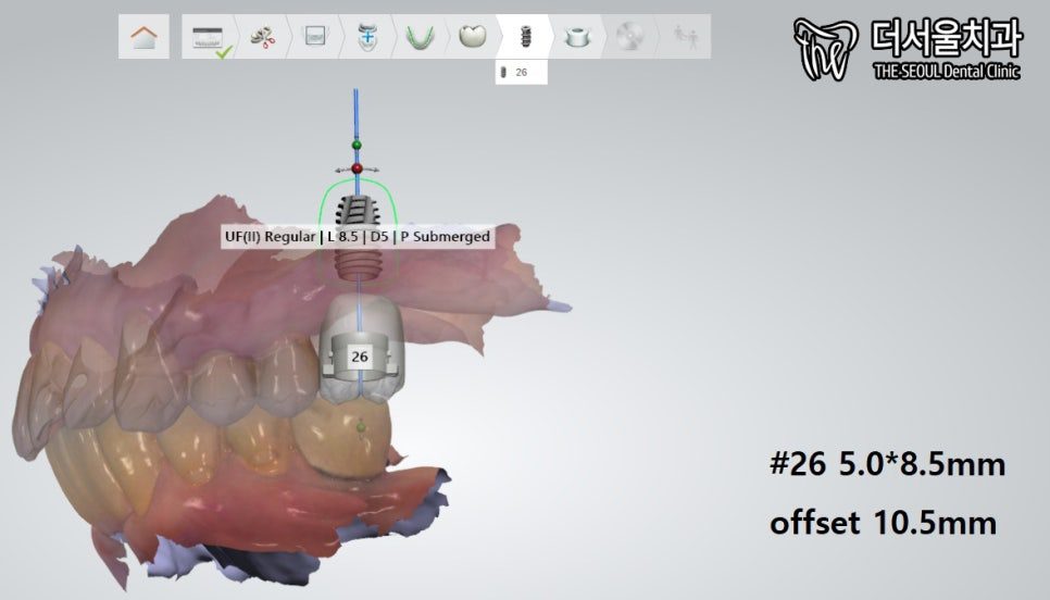 Three-dimensional digital scan of the upper teeth with the planned implant position and its dimensions marked