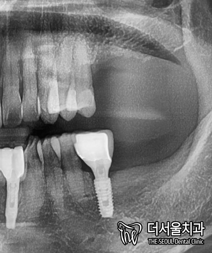 A Loose Molar That Looked Fine: Bone Loss Underneath