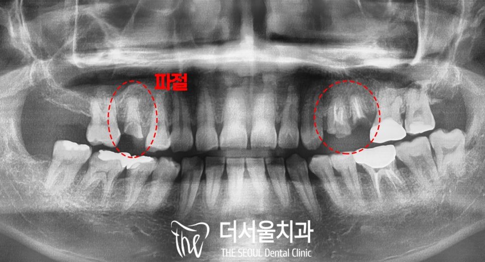 Fractured Molars: Extraction and Implant in the Same Appointment