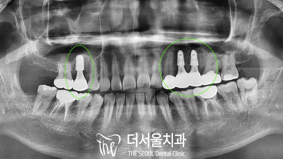 Panoramic dental X-ray with the implants placed and marked in green