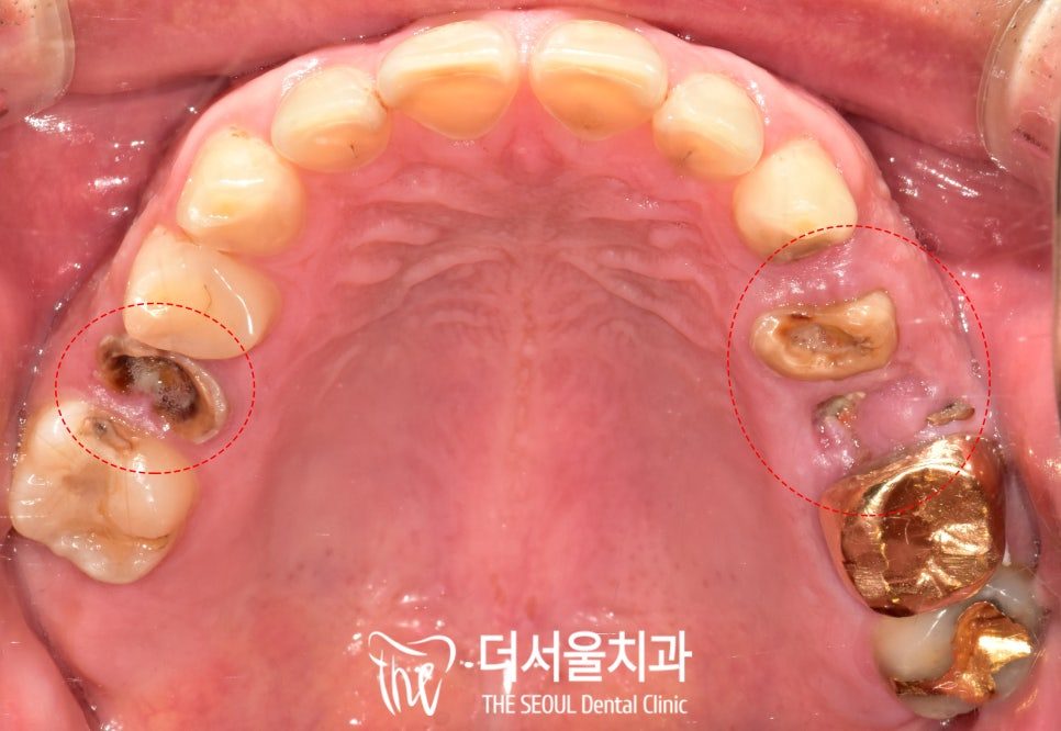 Intraoral photograph of the upper teeth from below showing broken and decayed back teeth on both sides