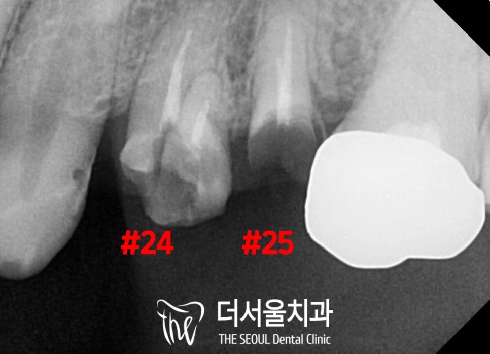 Close-up dental X-ray with two upper teeth marked by their tooth numbers beside a restoration