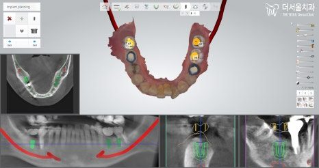 Planning software showing the dental arch from above with the planned implant positions marked