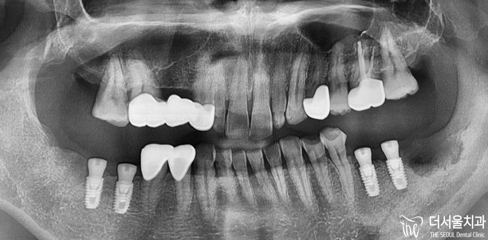 Root Infection and Multiple Missing Teeth: Rebuilding a Whole Bite