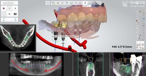 Implant planning software showing the arch scan beside cross-sectional slices of a planned implant site