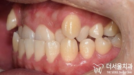 Correcting an Underbite Without Jaw Surgery: A 30-Month Case